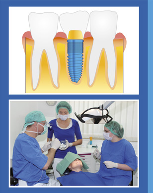 Implantate